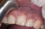 Figure 9 Case 3 soft-tissue collar removal with appropriate laser setting and tip.