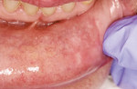Figure 15 Case 5 at 4 weeks post-treatment.