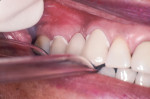 Figure 2 With resin-modified glass ionomer cement placed inside the crowns and bridge seated to be cemented, the patient bites down on a saliva ejector that has been bent to be a 