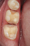 Figure 2 The teeth were prepared by first removing the defective restorations, and management of soft tissue was accomplished using diode lasers.