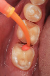 Figure 4 The Virtual XD light body fast set was injected around the prepared posterior teeth.
