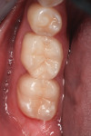 Figure 8 The final posterior lithium disilicate restorations were fabricated based on the master impression and seated intraorally.