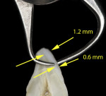 Figure 7 Enamel thickness decreases with age. To maintain value control, it is recommended that the enamel layer not exceed 0.6 mm.