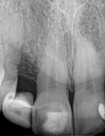 Figure 2 Radiograph showing significant bone loss in the edentulous area.