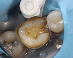 Figure 2 Glossy appearance of All-Bond Universal following light curing, prior to cementation.