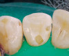 Figure 17 First-phase implants loaded with conical abutments and, in some cases, their angulated counterparts.