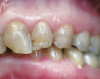 Figure 21 Endodontically treated tooth No. 8.