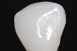 Figure 13 Note the high shine (similar to the surrounding glazed surface) created by the easy polishing protocol shown.