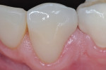 Figure 14 The final restoration at 1-month
postoperative. Note the healthy surrounding tissues and the esthetics obtained with the CAD/CAM lithium-disilicate crown.