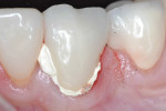 Figure 5 Facial view of provisional restoration, before removal of the excess temporary cement. Note the defect on the incisal edge, replicating the original crown that presented with chipping at this location.