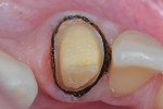 Figure 7 Occlusal view of retraction cords after rinsing hemostatic agent, which had been applied with an intraoral metallic tip attached to
syringe. Note the hemostasis and tissue retraction obtained prior to impressioning.