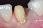 Figure 4 Hemostatic agent was applied to control the bleeding before the fabrication of the provisional restoration.