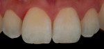Figure 16 Teeth with lens and flashes polarized. Note that there is no glare, and chroma gradations can be easily visualized.