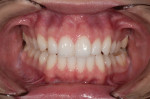 Figure 10 Cheeks retracted full-arch view with teeth slightly separated. F-stop: 32 (or higher); between 1:2.5 and 1:3 magnification.