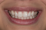 Figure 13 Lower one-third of face smiling view with teeth slightly separated. F-stop: 32 (or higher); between 1:2.5 and 1:3 magnification.