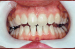 Figure 1. Prior to at-home whitening.