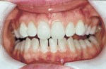 Figure 2. Following approximately 10 days of at-home tray whitening.