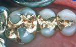 Figure 4 Ms. Hepburn's maxillary gold restorations (right).