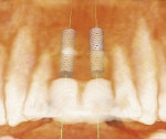 Figure 2 Cross-sectional view of the proposed implant position. Note that the plan allows the restorative dentist and surgeon to confirm the implants' positions, inclination, depth, and emergence.