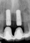 Figure 3 Radiograph confirming that the implant placement matches the presurgical plan.