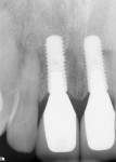 Figure 4 Radiograph taken on the day of delivery of the final implant-supported restorations 3 months after implant placement.