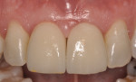 Figure 5 Clinical presentation of implants No. 8 and No. 9 two years after implant placement.