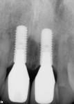 Figure 6 Radiograph of crowns No. 8 and No. 9 two years after implant placement.