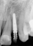 Figure 9 Radiograph taken at the time of implant placement confirming that the implant is precisely positioned matching the presurgical plan.