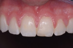 Figure 1 Preoperative view showing the fialing mesial incisal composite, tooth No. 9.