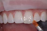 Figure 5 Achromatic enamel is layered from the primary bevel and feathered to the incisal and proximal cavosurface.