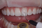 Figure 7 Surface luster must be managed without the loss of texture and anatomy that allows the restoration to harmonize with the balance of the dentition.