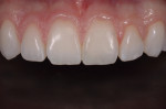 Figure 8 Final restoration, tooth No. 9.