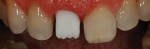 Figure 12 Intraoral view of Lava's masking ability.
