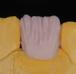 Figure 17 Dentins applied over opacious dentin.