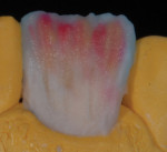 Figure 20 Opacious dentin and dentin mix again used as mamalon materials.
