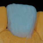 Figure 21 Enamels applied over canvas of dentins and effects powders.
