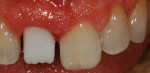 Figure 28 The more opacified core allows for masking and a boost to the overall value of the final restoration.