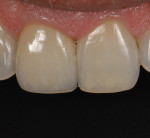 Figure 31 Single central No. 8 with composite incisal edge No. 9.