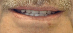 Figure 3 The patient's current denture is analyzed, checking the arrangement of teeth.