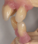 Figure 8 Lower canine is setup according to placement of upper canine.