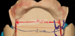 Figure 14 The paster bite rim is analyzed for proper posterior placement.