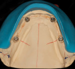Figure 15 The putty index is used as guideline for buccal placement.
