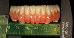 Figure 16 The posterior width of the final denture measures 5.5 cm.