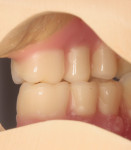 Figure 21 Posterior teeth set in lingualized occlusoin.