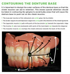 Figure 43 Contouring the denture base.