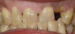 Figure 1 The patient presented with failing dentition and was deemed a candidate for dental surgery.