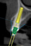 Figure 2 Guided surgery file shows planned implant placement and prosthetic restoration.