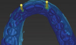 Figure 3 The digital impression file and guided surgery files are overlaid and used to visualize the current dentition and facilitate planning for the ideal restorative outcome.