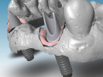 Figure 9 Abutments were designed using CARES® Visual 8.0 Software for teeth Nos. 7 and 10.
