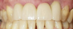 Figure 13 The final zirconia framework cemented in the mouth.